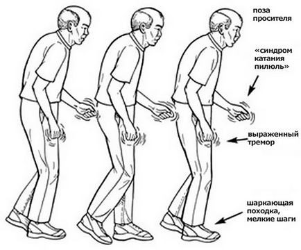 Sindromul de instabilitate posturală în bolile Parkinson și SNC