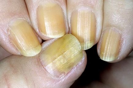 Склероніхія нігтів - ознаки і лікування