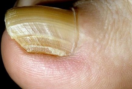 Склероніхія нігтів - ознаки і лікування