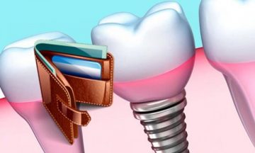 Cât costă un factor de cost implant dentar, servicii suplimentare