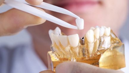 Cât costă un factor de cost implant dentar, servicii suplimentare