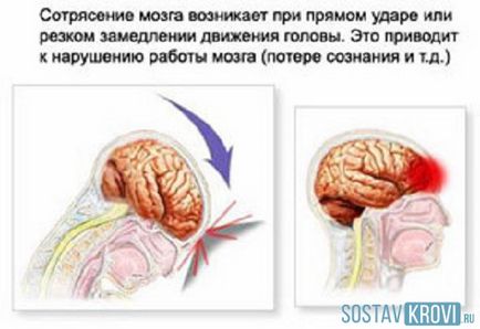 Concussion al simptomelor creierului, tratamentul, la copii, primul ajutor cu un shake