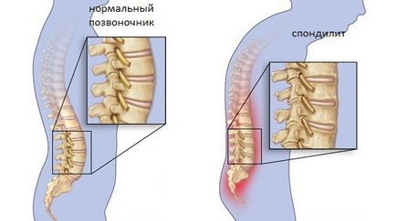 гръбначния стълб спондилит - причини, симптоми и лечение