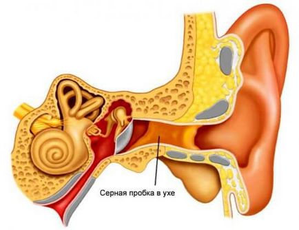 Metode și metode de îndepărtare a plutei de sulf din ureche