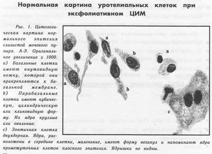 Стаття цитологічне дослідження сечі (ЦІМ), (м