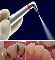 Stomatologie în sud-vest - tratamentul implantării protezelor dentare - Moscova dentară