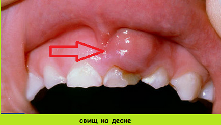 Fistula pe gumă - tratament la domiciliu, antibiotice, remedii populare