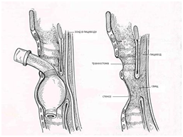 Simptome fistula traheofistinale, tratament