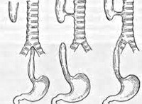 Fistula traheofistinală - cauze, simptome, diagnostic și tratament