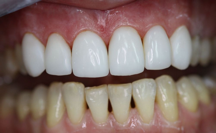 Трьома зубів лікування, причини, небезпека