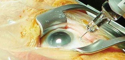 Trei injectări de lucentis în ochiul stâng