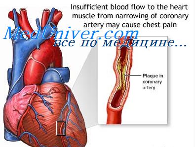 Тромбоемболічні ускладнення інфаркту міокарда