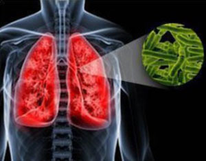 Туберкульоз легень - перші симптоми у дорослих, наслідки