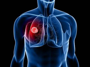 Tuberculoza plămânilor - primele simptome la adulți, consecințele