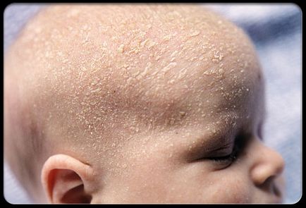 Gondozása újszülött bőr (bőrpír Mérgező újszülöttek) Skin Care újszülött