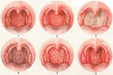види фарингіту
