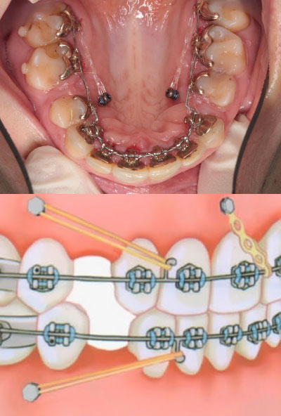 Види зубних імплантів які краще