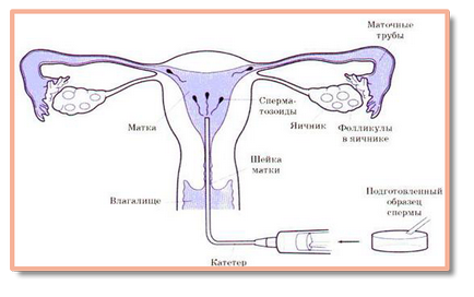 Inseminarea intrauterină în Perm