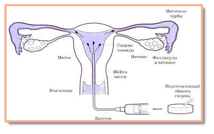 Внутрішньоматкова інсемінація в пермі