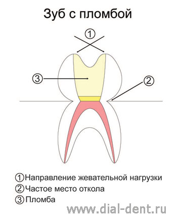 Відновлення розколотого депульпірованного зуба
