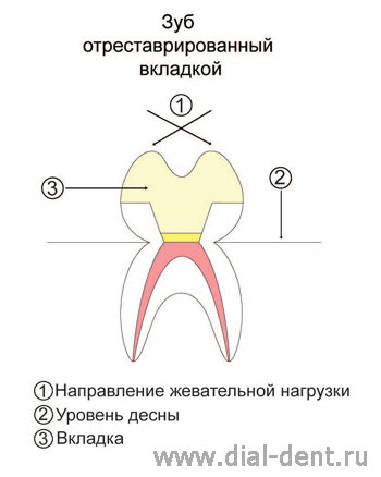 Відновлення розколотого депульпірованного зуба