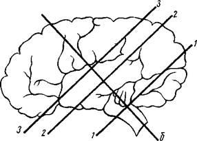 Autopsia creierului