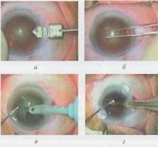 Tratamentul chirurgical al cataractei