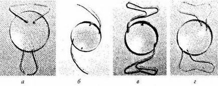 Tratamentul chirurgical al cataractei