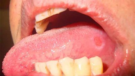 Răni în gură fotografie, cauze și tratament