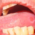 Виразки в роті фото, причини і лікування