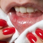 Виразки в роті фото, причини і лікування