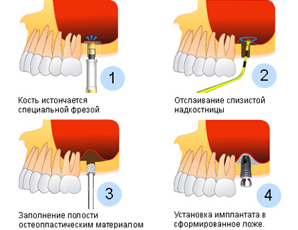 Înălțimea sinusoidală închisă și deschisă - care este diferența