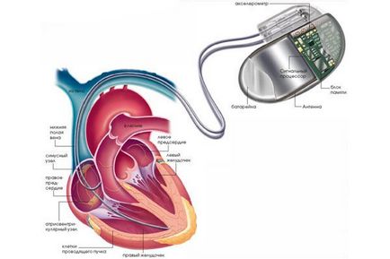 Життя з кардіостимулятором - тривалість, правила і обмеження