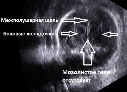 Corpus callosum agenesia