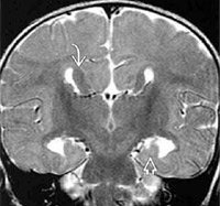 Agenesis al efectelor corpus callosus, simptome și tratament - enciclopedia medicală - viața mea