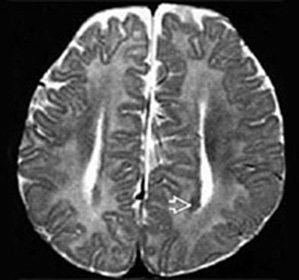 Agenesis al efectelor corpus callosus, simptome și tratament - enciclopedia medicală - viața mea