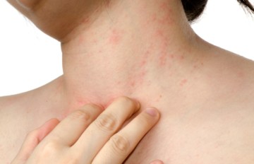 Алергічний свербіж шкіри - з чим пов'язана його виникнення, механізм розвитку алергії, можливість