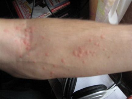 Алергія на арахіс симптоми і лікування