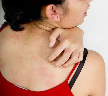 Алергія на сонце симптоми, причини, лікування, профілактика - краса і здоров'я