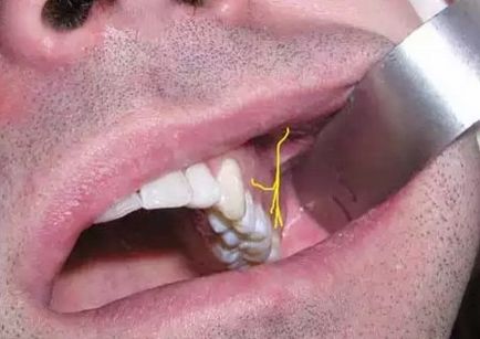 Anesztézia a maxilla (felső állkapocs érzéstelenítés) Altatás arcüreg