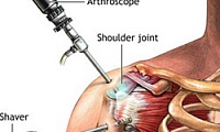 Artroscopia articulației genunchiului - clinica de traumatologie și ortopedie 