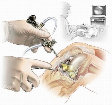 Térd arthroscopy Chelyabinsk (térd arthroscopy) Térd arthroscopy Cseljabinszk