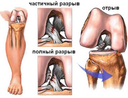 Artroscopia genunchiului din Chelyabinsk