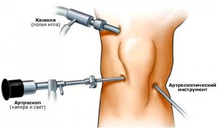 Artroscopia articulației genunchiului din clinica Dr. Oksakov din Moscova