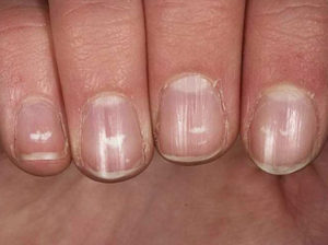 Білі смуги на нігтях причини появи і способи лікування, фото