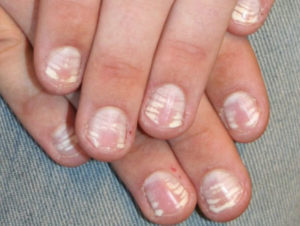 Білі смуги на нігтях причини появи і способи лікування, фото