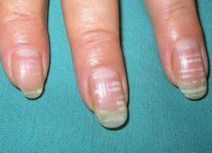 Dungile albe pe unghii sunt motivele pentru aparitia si modalitatile de tratament, foto