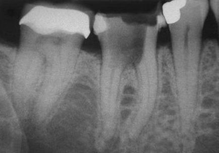 Bifurcația rădăcinilor dintelui