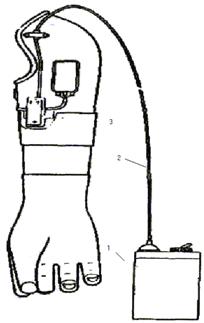 Antebraț protetic biocontrolat