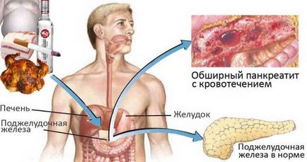 Болить шлунок після алкоголю і пива що робити і чим лікувати